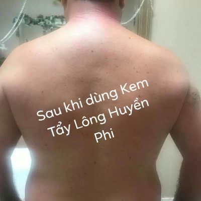 triệt lông body triệt lông body
