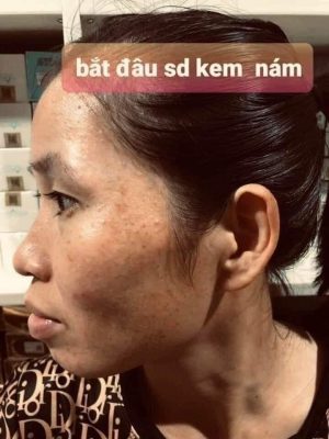 khi mới dùng kem nám khi mới dùng kem nám
