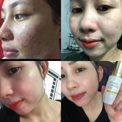 Da trắng mịn đẩy hết mụn sau khi dùng combo tái sinh Da trắng mịn đẩy hết mụn sau khi dùng combo tái sinh