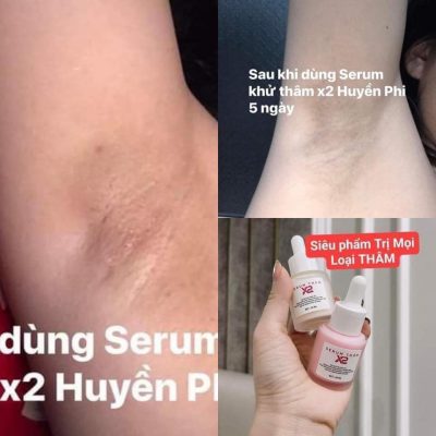 Khách hàng sử dụng cho khử thâm vùng nách Khách hàng sử dụng cho khử thâm vùng nách