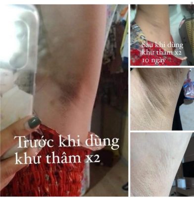 Hiệu quả cải thiện rõ rệt sau khi dùng sản phẩm Hiệu quả cải thiện rõ rệt sau khi dùng sản phẩm